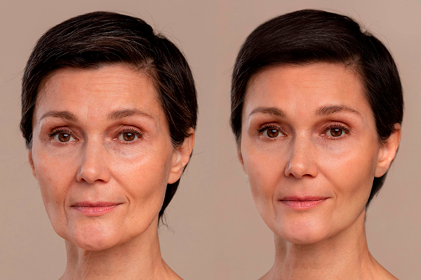 antes-e-depois-harmonizacao-2